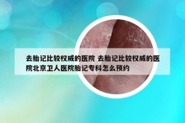 去胎记比较权威的医院 去胎记比较权威的医院北京卫人医院胎记专科怎么预约