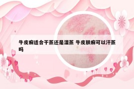 牛皮癣适合干蒸还是湿蒸 牛皮肤癣可以汗蒸吗