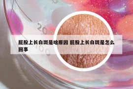 屁股上长白斑是啥原因 屁股上长白斑是怎么回事