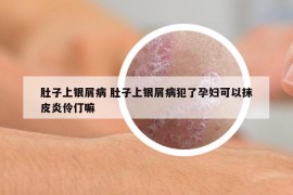 肚子上银屑病 肚子上银屑病犯了孕妇可以抹皮炎伶仃嘛