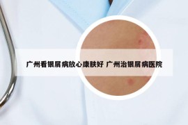 广州看银屑病放心康肤好 广州治银屑病医院
