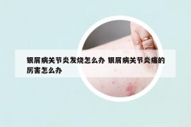 银屑病关节炎发烧怎么办 银屑病关节炎痛的厉害怎么办