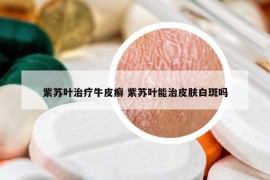 紫苏叶治疗牛皮癣 紫苏叶能治皮肤白斑吗