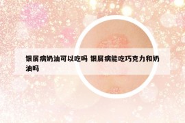 银屑病奶油可以吃吗 银屑病能吃巧克力和奶油吗