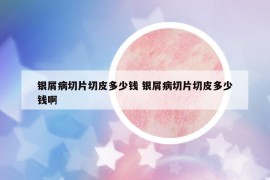 银屑病切片切皮多少钱 银屑病切片切皮多少钱啊