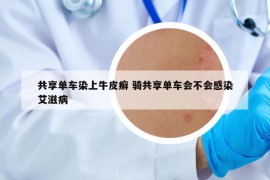 共享单车染上牛皮癣 骑共享单车会不会感染艾滋病