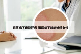 银屑病下蹲能好吗 银屑病下蹲能好吗女性
