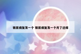 银屑病复发一个 银屑病复发一个月了还痒