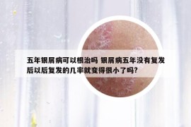 五年银屑病可以根治吗 银屑病五年没有复发后以后复发的几率就变得很小了吗?