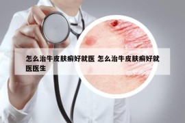怎么治牛皮肤癣好就医 怎么治牛皮肤癣好就医医生