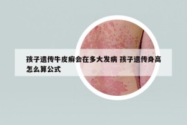 孩子遗传牛皮癣会在多大发病 孩子遗传身高怎么算公式