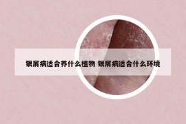 银屑病适合养什么植物 银屑病适合什么环境