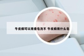 牛皮癣可以用香皂洗不 牛皮癣用什么皂