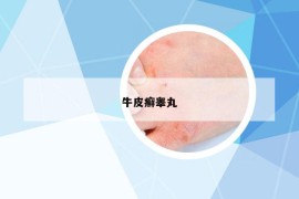 牛皮癣睾丸