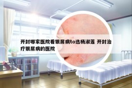 开封哪家医院看银屑病to选杨淑莲 开封治疗银屑病的医院
