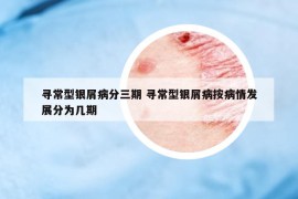 寻常型银屑病分三期 寻常型银屑病按病情发展分为几期
