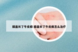 膝盖长了牛皮癣 膝盖长了牛皮癣怎么治疗