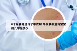 6个月婴儿遗传了牛皮癣 牛皮肤癣遗传宝宝的几率是多少