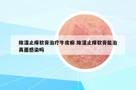 除湿止痒软膏治疗牛皮癣 除湿止痒软膏能治真菌感染吗