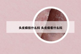 头皮癣挂什么科 头皮癣看什么科