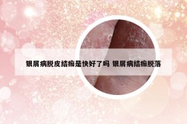 银屑病脱皮结痂是快好了吗 银屑病结痂脱落