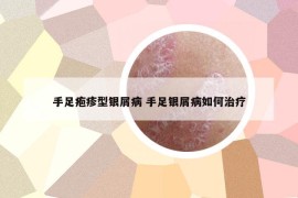 手足疱疹型银屑病 手足银屑病如何治疗