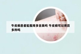 牛皮癣患者能服用多吉美吗 牛皮癣可以用百多邦吗