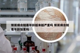 银屑病会随着年龄越来越严重吗 银屑病会随着年龄加重吗