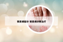 银屑病疑诊 银屑病诊断治疗