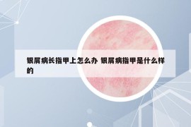银屑病长指甲上怎么办 银屑病指甲是什么样的