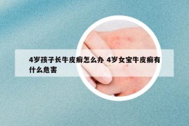 4岁孩子长牛皮癣怎么办 4岁女宝牛皮癣有什么危害