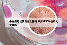牛皮癣可以使用凡士林吗 银屑病可以使用凡士林吗