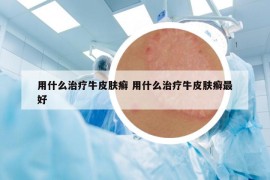 用什么治疗牛皮肤癣 用什么治疗牛皮肤癣最好