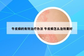 牛皮癣的有效治疗办法 牛皮癣怎么治效果好
