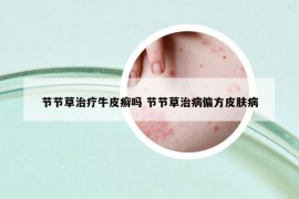 节节草治疗牛皮癣吗 节节草治病偏方皮肤病