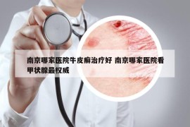 南京哪家医院牛皮癣治疗好 南京哪家医院看甲状腺最权威