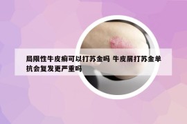 局限性牛皮癣可以打苏金吗 牛皮屑打苏金单抗会复发更严重吗