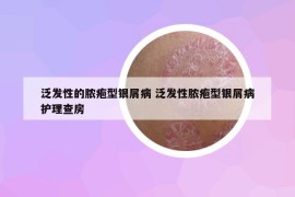泛发性的脓疱型银屑病 泛发性脓疱型银屑病护理查房