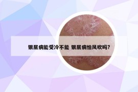银屑病能受冷不能 银屑病怕风吹吗?