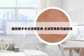 扁桃腺手术点滴银屑病 点滴型银屑切扁桃体