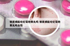 银屑病能吃杞菊地黄丸吗 银屑病能吃杞菊地黄丸吗女性