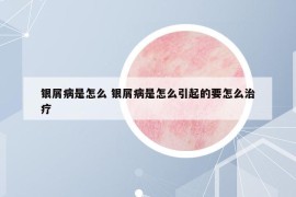 银屑病是怎么 银屑病是怎么引起的要怎么治疗