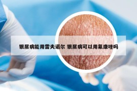 银屑病能用雷夫诺尔 银屑病可以用氟康唑吗