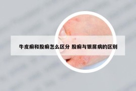 牛皮癣和股癣怎么区分 股癣与银屑病的区别