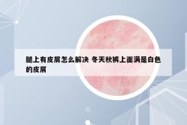 腿上有皮屑怎么解决 冬天秋裤上面满是白色的皮屑