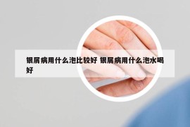 银屑病用什么泡比较好 银屑病用什么泡水喝好