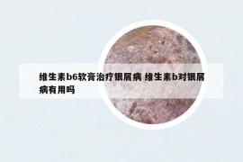 维生素b6软膏治疗银屑病 维生素b对银屑病有用吗