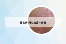 维生素c可以治疗牛皮癣