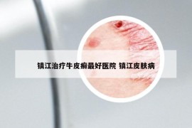 镇江治疗牛皮癣最好医院 镇江皮肤病