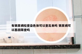 有银屑病检查染色体可以查出来吗 银屑病可以基因筛查吗